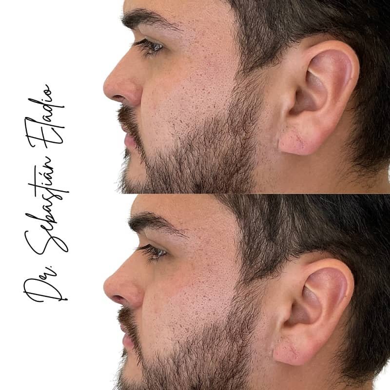 Antes y después de rinomodelación masculina para mejorar el perfil nasal sin cirugía.