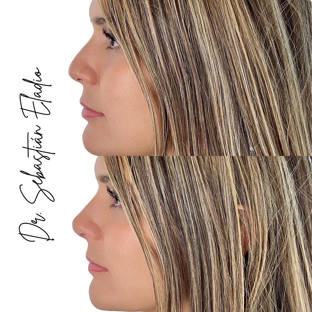 Perfil nasal femenino mejorado con rinomodelación definitiva sin cirugía.