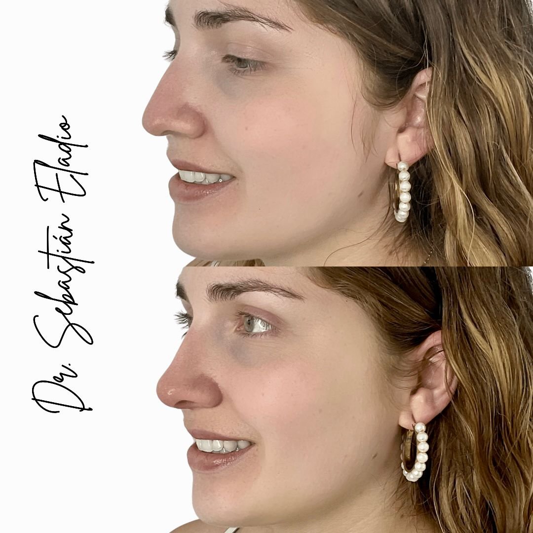 Cambio natural con rinomodelación estética facial realizada por el Dr. Sebastián Eladio.