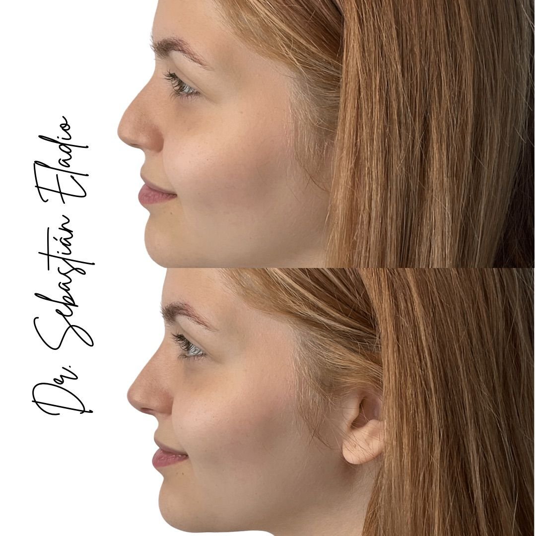 Rinomodelación estructurada para definir el perfil nasal y armonizar el rostro.