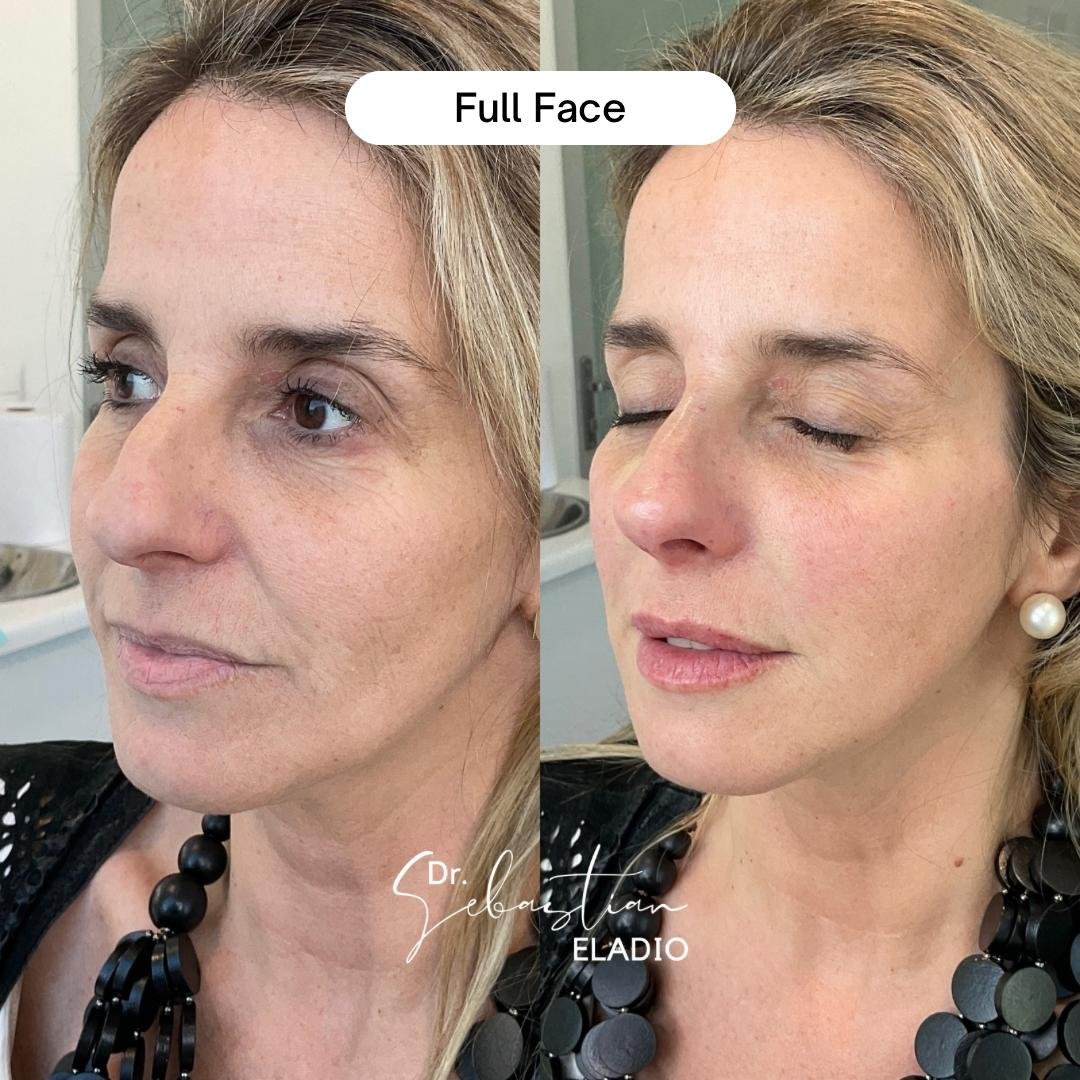 Antes y después de rejuvenecimiento facial Full Face