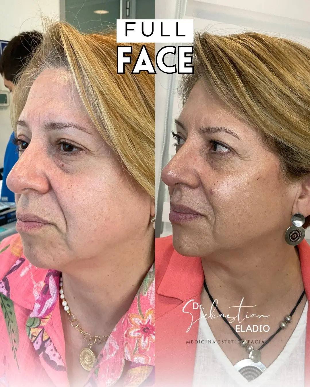 Resultado Full Face con armonización y firmeza facial