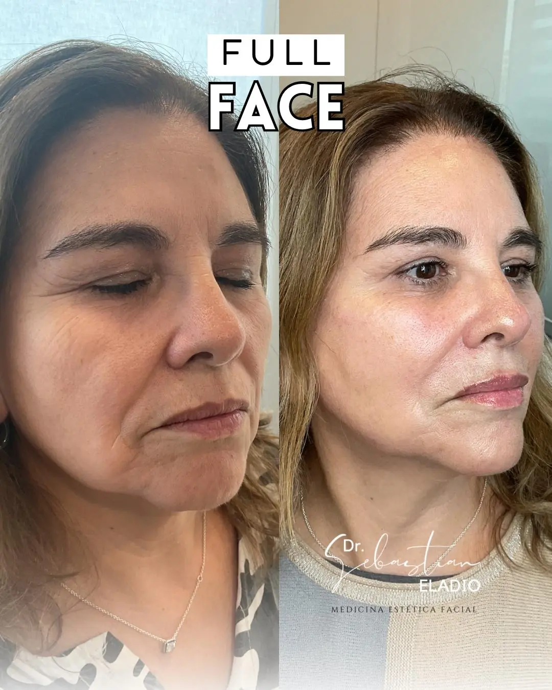 Tratamiento Full Face para rejuvenecimiento facial natural