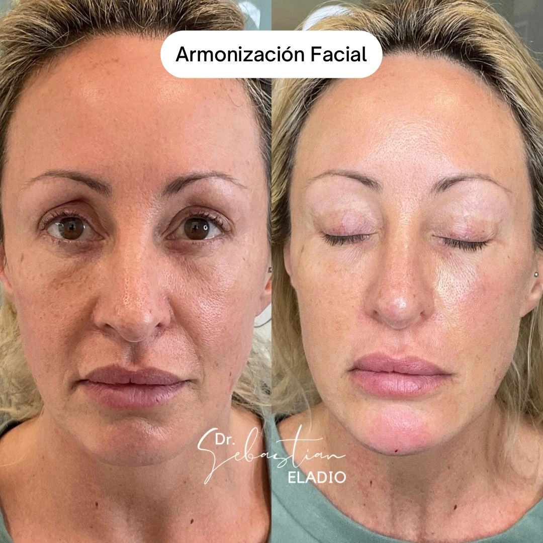 Antes y después de perfilamiento facial femenino con ácido hialurónico inyectable.