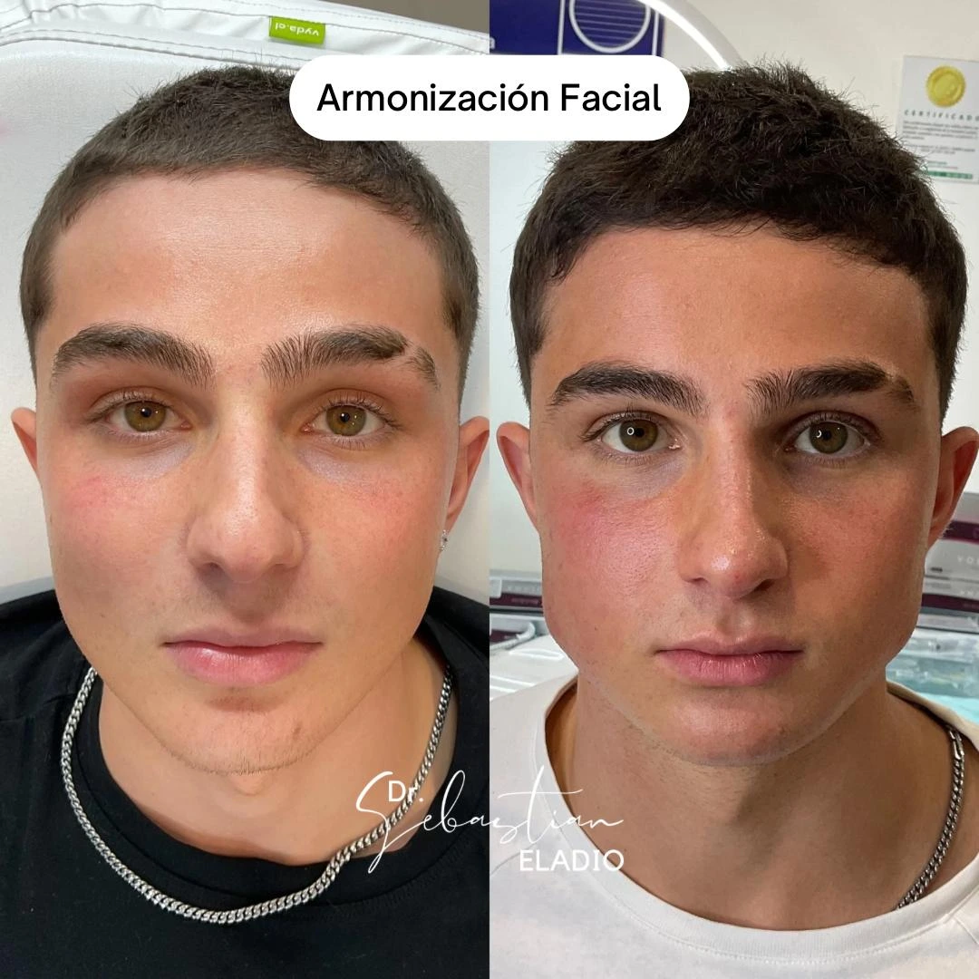 Armonización facial masculina con resultados naturales y definición facial armónica.