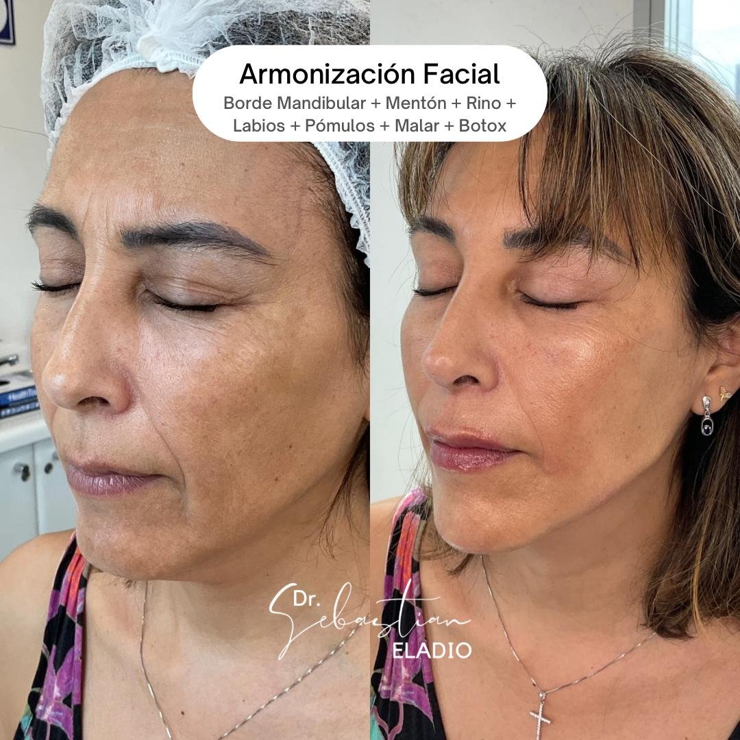 Resultado de armonización facial con ácido hialurónico en mentón, mandíbula y pómulos.