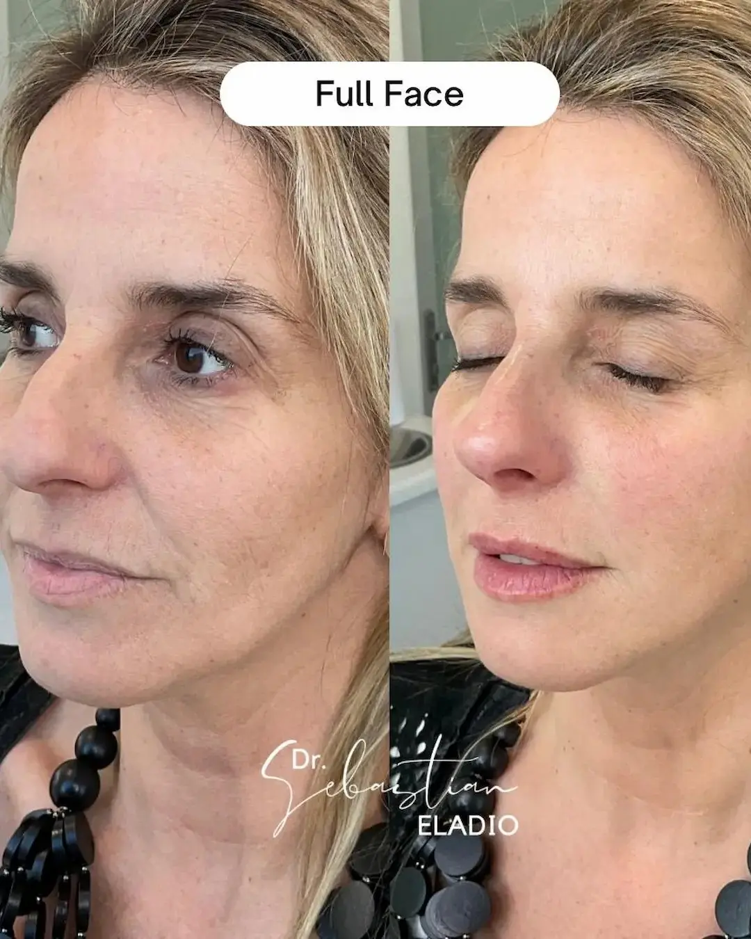 Antes y después de rejuvenecimiento facial Full Face